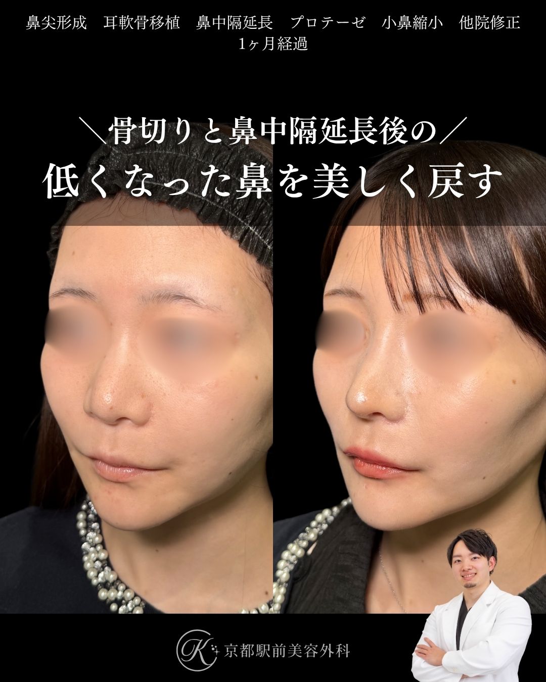 骨切りと他院鼻中隔延長術後の低くなった鼻を美しく戻す。鼻尖形成、耳軟骨移植、鼻中隔延長、プロテーゼ、小鼻縮小、他院修正など（京都駅前美容外科の症例）当院は滋賀、京都、大阪をはじめとした関西圏や全国から患者様にお越しいただいています。