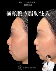 額こめかみの脂肪注入、顎のボトックス・ヒアルロン酸の症例(京都駅前美容外科の症例写真)。額やこめかみの凹みや痩せを改善し、女性らしい丸い額を作ります。当院は滋賀、京都、大阪をはじめとした関西圏や全国から患者様にお越しいただいています。