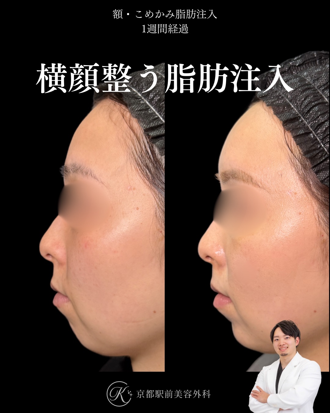 額こめかみの脂肪注入、顎のボトックス・ヒアルロン酸の症例（京都駅前美容外科の症例写真）。額やこめかみの凹みや痩せを改善し、女性らしい丸い額を作ります。当院は滋賀、京都、大阪をはじめとした関西圏や全国から患者様にお越しいただいています。