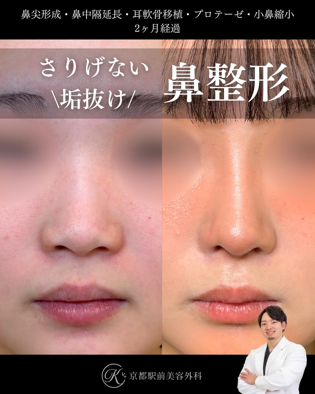 鼻整形（鼻尖形成オープン法・耳軟骨移植・小鼻縮小・鼻中隔延長術・プロテーゼ）の術直後写真（京都駅前美容外科の症例）当院では滋賀、京都、大阪をはじめとした関西圏や全国から患者様にお越しいただいています。