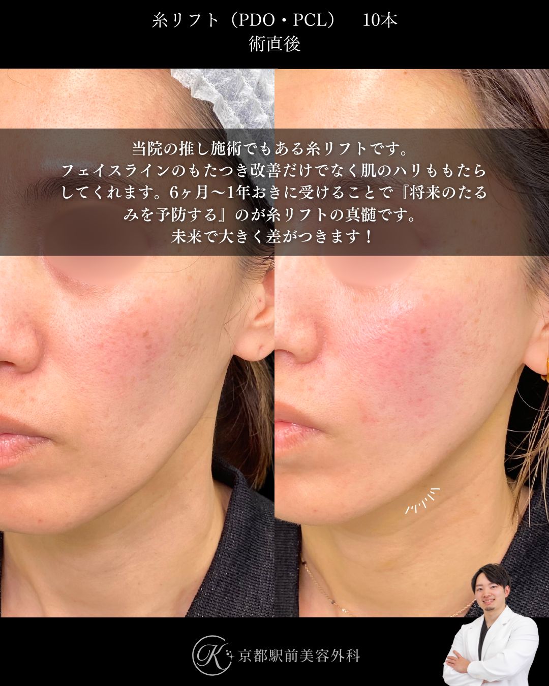 肌にハリを戻す！たるみを改善する糸リフト。京都駅前美容外科の症例画像。当院は滋賀、京都、大阪をはじめとした関西圏や全国から患者様にお越しいただいています。