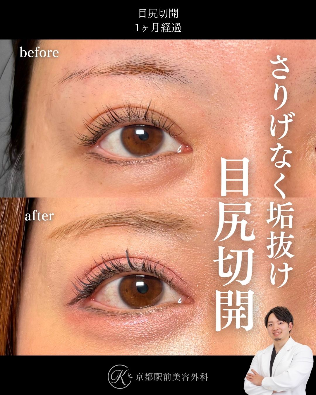 目尻切開の術直後写真（京都駅前美容外科の症例）当院は滋賀、京都、大阪をはじめとした関西圏や全国から患者様にお越しいただいています。