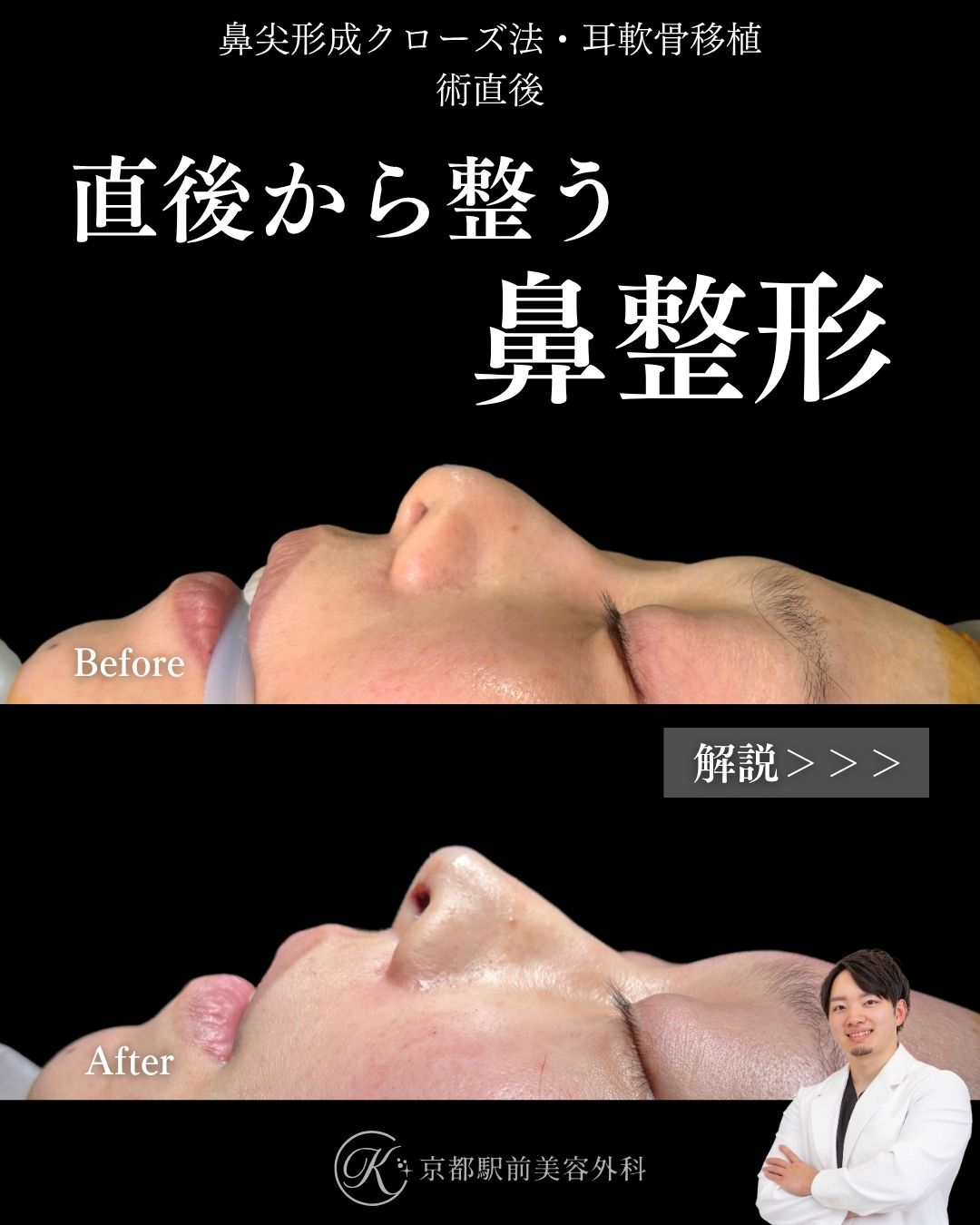 鼻尖形成クローズ法と耳軟骨移植の術直後です。腫れにくい、バレにくい、鼻整形の方法の1つです。鼻筋から鼻先にかけてストレートなラインができるように調整し、鼻先の丸みも改善しています。関西、大阪、京都、滋賀で鼻整形は京都駅前美容外科にお任せを。