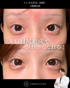 タレ目形成(グラマラスライン形成)(皮膚結膜)、目尻切開の術後経過。京都駅前美容外科の症例画像。当院は滋賀、京都、大阪をはじめとした関西圏や全国から患者様にお越しいただいています。