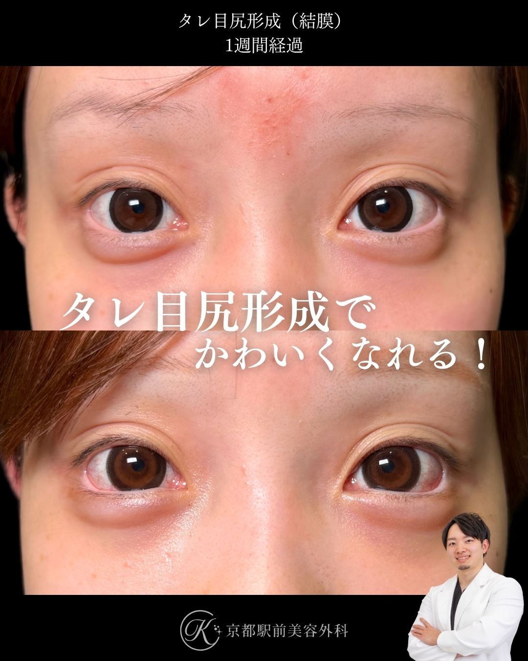 タレ目形成（グラマラスライン形成）（皮膚結膜）、目尻切開の術後経過。京都駅前美容外科の症例画像。当院は滋賀、京都、大阪をはじめとした関西圏や全国から患者様にお越しいただいています。
