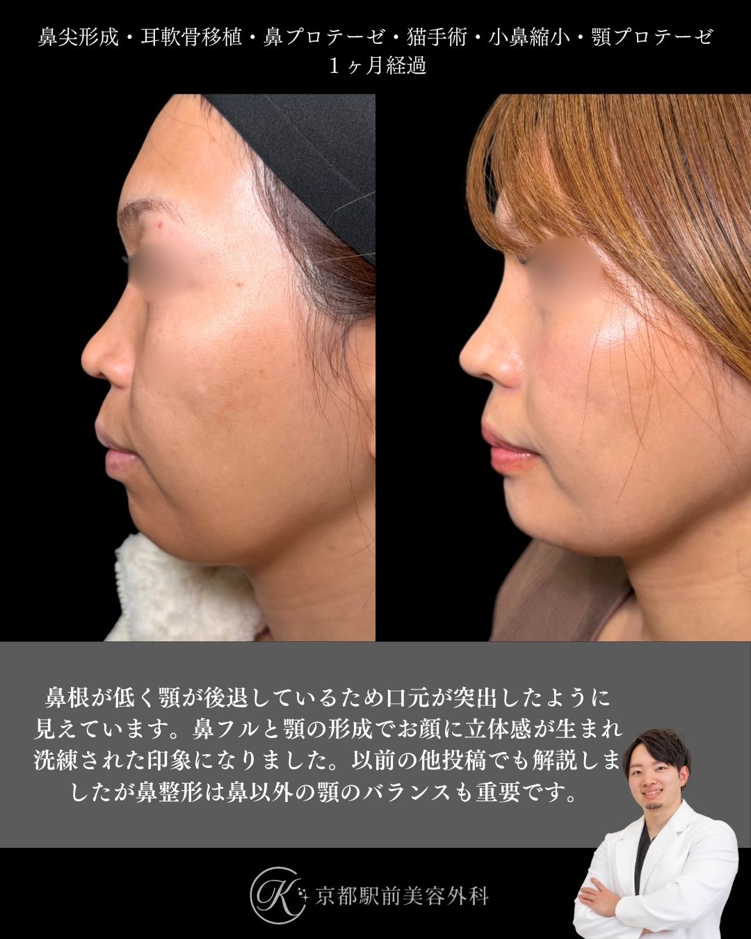 鼻尖形成・耳軟骨移植・鼻プロテーゼ・猫手術・小鼻縮小・顎プロテーゼの１ヶ月後写真（京都駅前美容外科の鼻整形症例）当院は滋賀、京都、大阪をはじめとした関西圏や全国から患者様にお越しいただいています。
