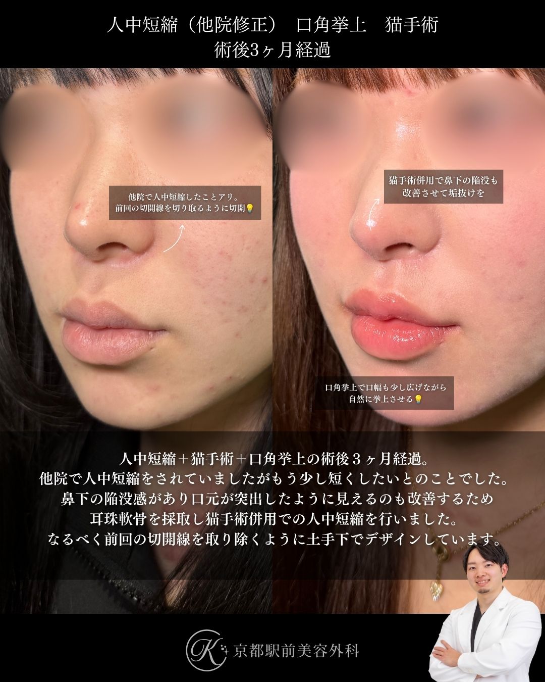 ２回目の人中短縮。人中短縮、口角挙上、猫手術（鼻唇角形成）の術後経過。京都駅前美容外科の症例画像。当院は滋賀、京都、大阪をはじめとした関西圏や全国から患者様にお越しいただいています。