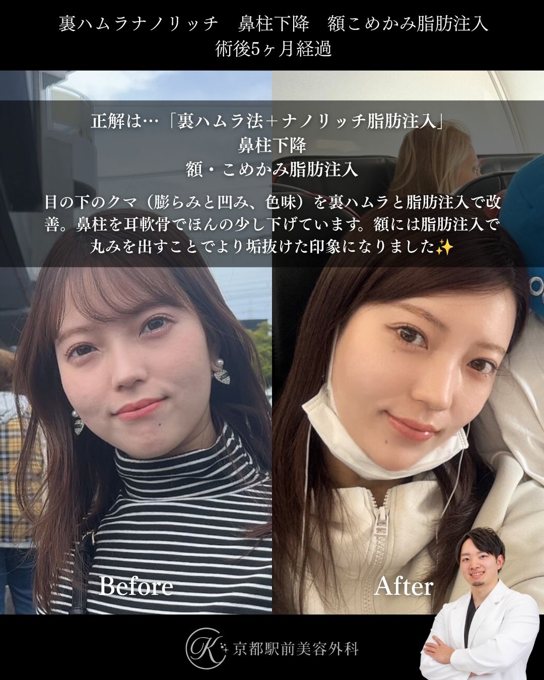 裏ハムラ法（クマ取り）＋目の下ナノリッチ脂肪注入、鼻柱下降、額の脂肪注入の術後経過写真（京都駅前美容外科の症例）です。目の下の膨らみはわずかですが色味が気になるとのことで脂肪注入で色味を改善させました。鼻や額も微調整を行い自然に垢抜けを図ることができました。とても喜んでいただけました。当院では滋賀、京都、大阪をはじめとした関西圏や全国から患者様にお越しいただいています。