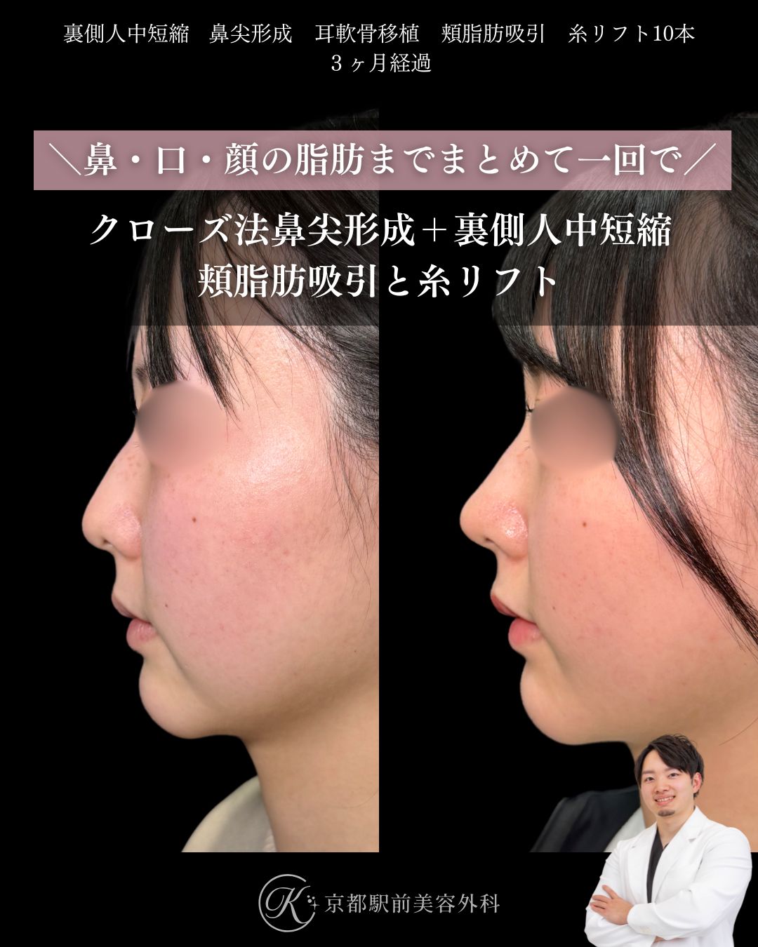 頬脂肪吸引、糸リフト、クローズ法の鼻尖形成、耳軟骨移植、裏側人中短縮の症例（京都駅前美容外科の症例写真）当院は滋賀、京都、大阪をはじめとした関西圏や全国から患者様にお越しいただいています。