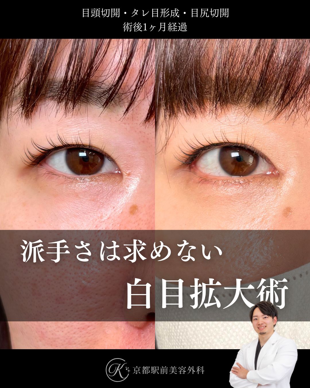 タレ目形成（グラマラスライン形成）（皮膚結膜）、目尻切開、目頭切開の術後経過。京都駅前美容外科の症例画像。当院は滋賀、京都、大阪をはじめとした関西圏や全国から患者様にお越しいただいています。