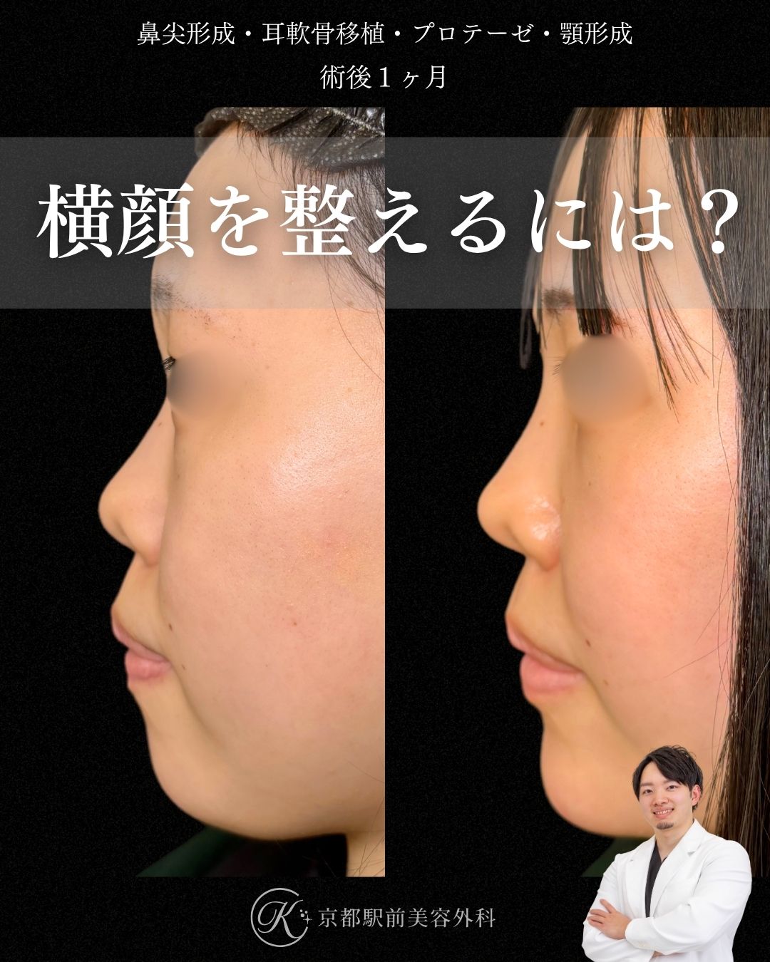 鼻尖形成・耳軟骨移植・プロテーゼ・顎プロテーゼの１ヶ月後写真（京都駅前美容外科の鼻整形症例）当院は滋賀、京都、大阪をはじめとした関西圏や全国から患者様にお越しいただいています。