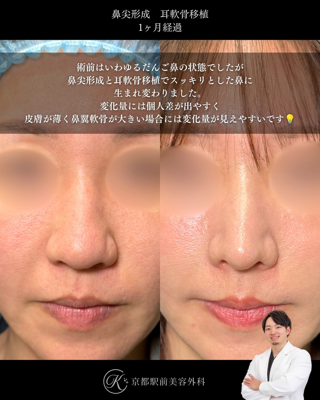 だんご鼻卒業、スッキリした鼻を作る鼻整形。鼻尖形成・耳軟骨移植の１ヶ月経過写真（京都駅前美容外科の鼻整形症例）当院は滋賀、京都、大阪をはじめとした関西圏や全国から患者様にお越しいただいています。