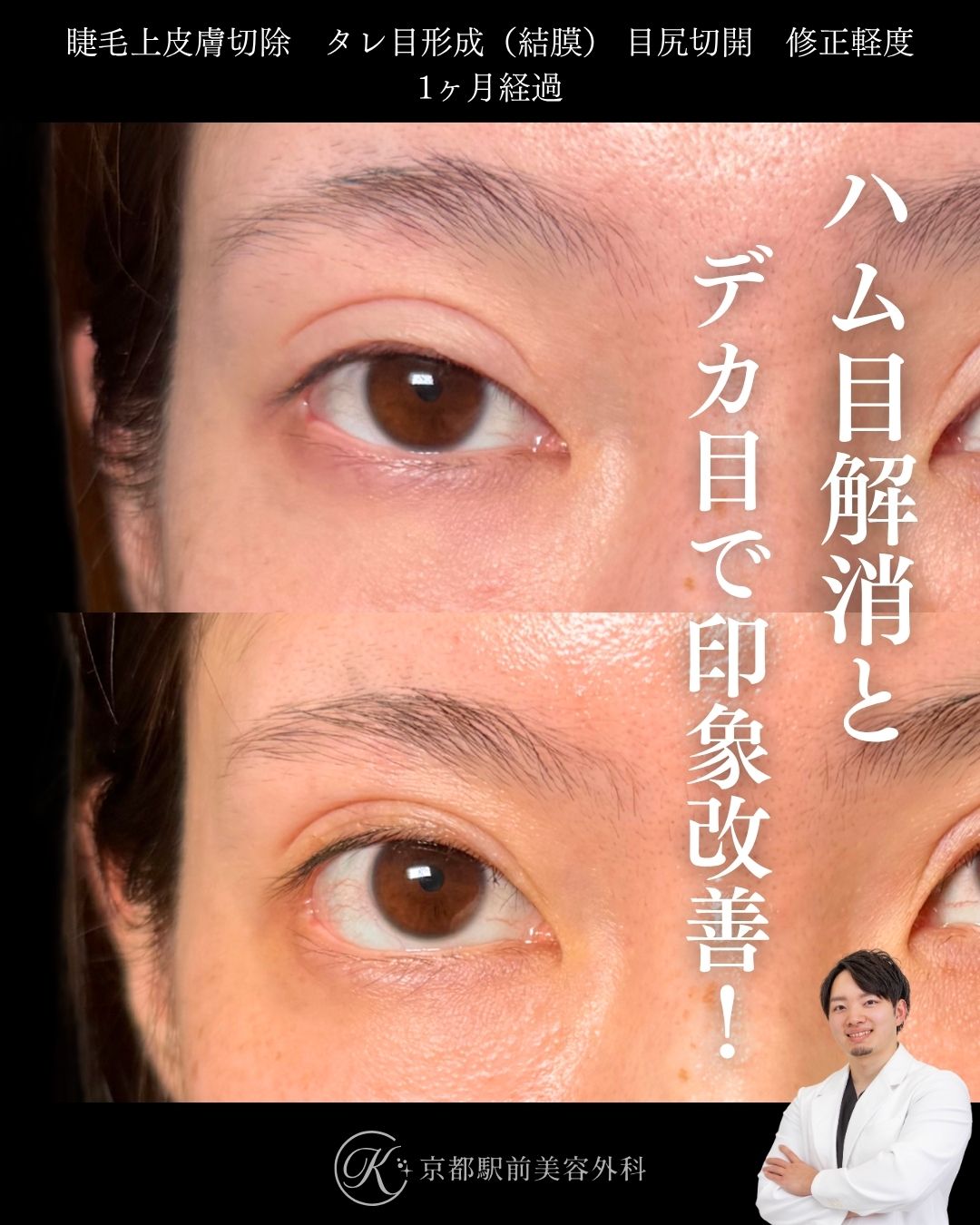 睫毛上皮膚切除でハム目解消、タレ目形成（グラマラスライン形成）と目尻切開でデカ目に。京都駅前美容外科の症例画像。当院は滋賀、京都、大阪をはじめとした関西圏や全国から患者様にお越しいただいています。