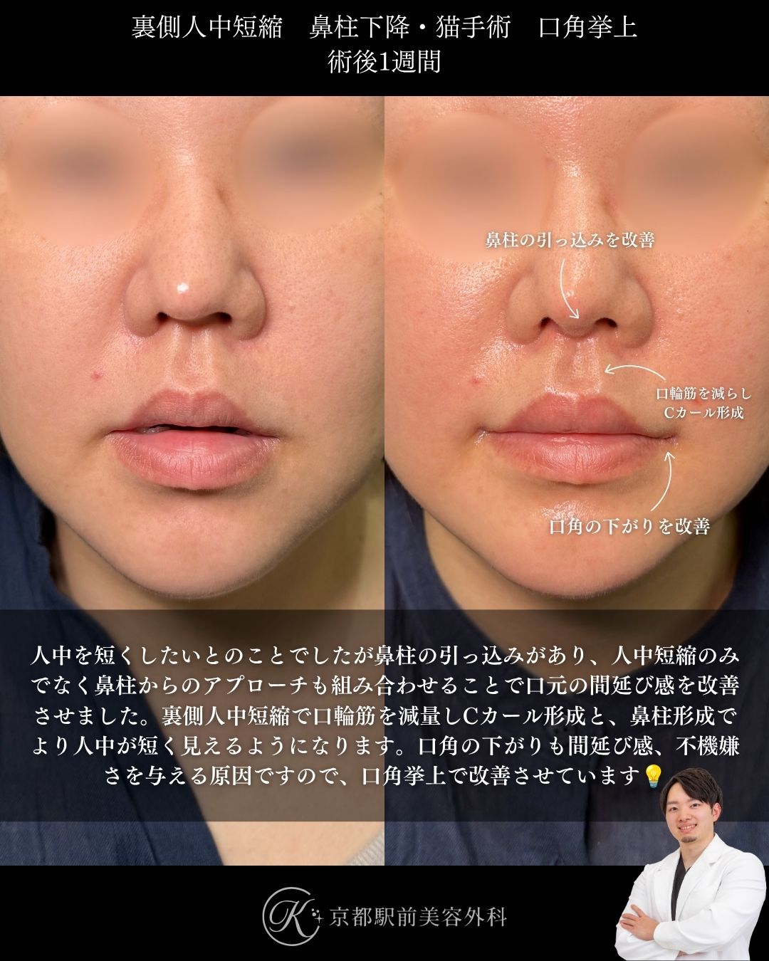 裏側人中短縮、口角挙上（全層法）、鼻柱下降、口角挙上の症例（京都駅前美容外科の症例写真）当院は滋賀、京都、大阪をはじめとした関西圏や全国から患者様にお越しいただいています。