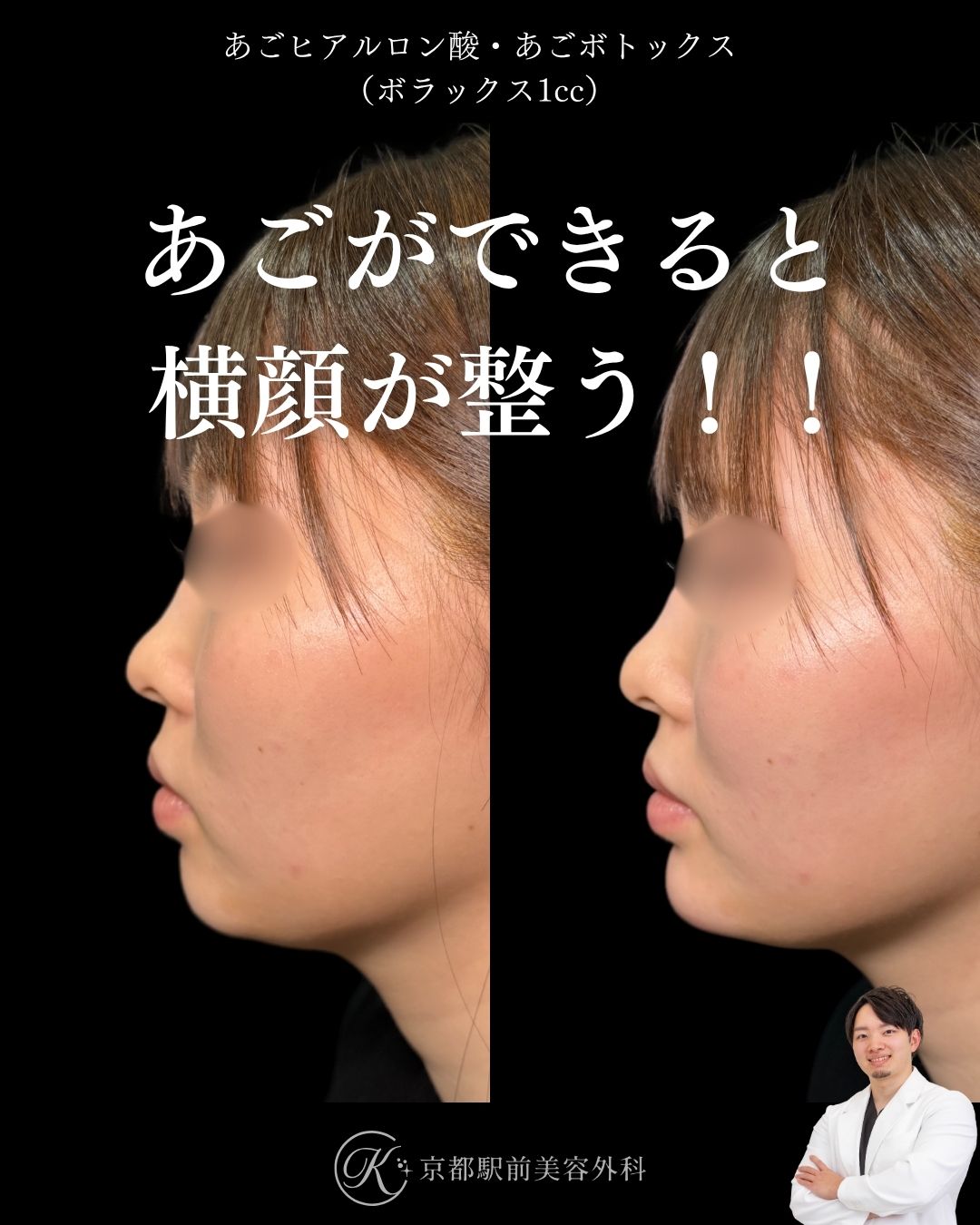 あごヒアルロン酸とあごボトックスで横顔が整う！京都駅前美容外科の症例画像。当院は滋賀、京都、大阪をはじめとした関西圏や全国から患者様にお越しいただいています。