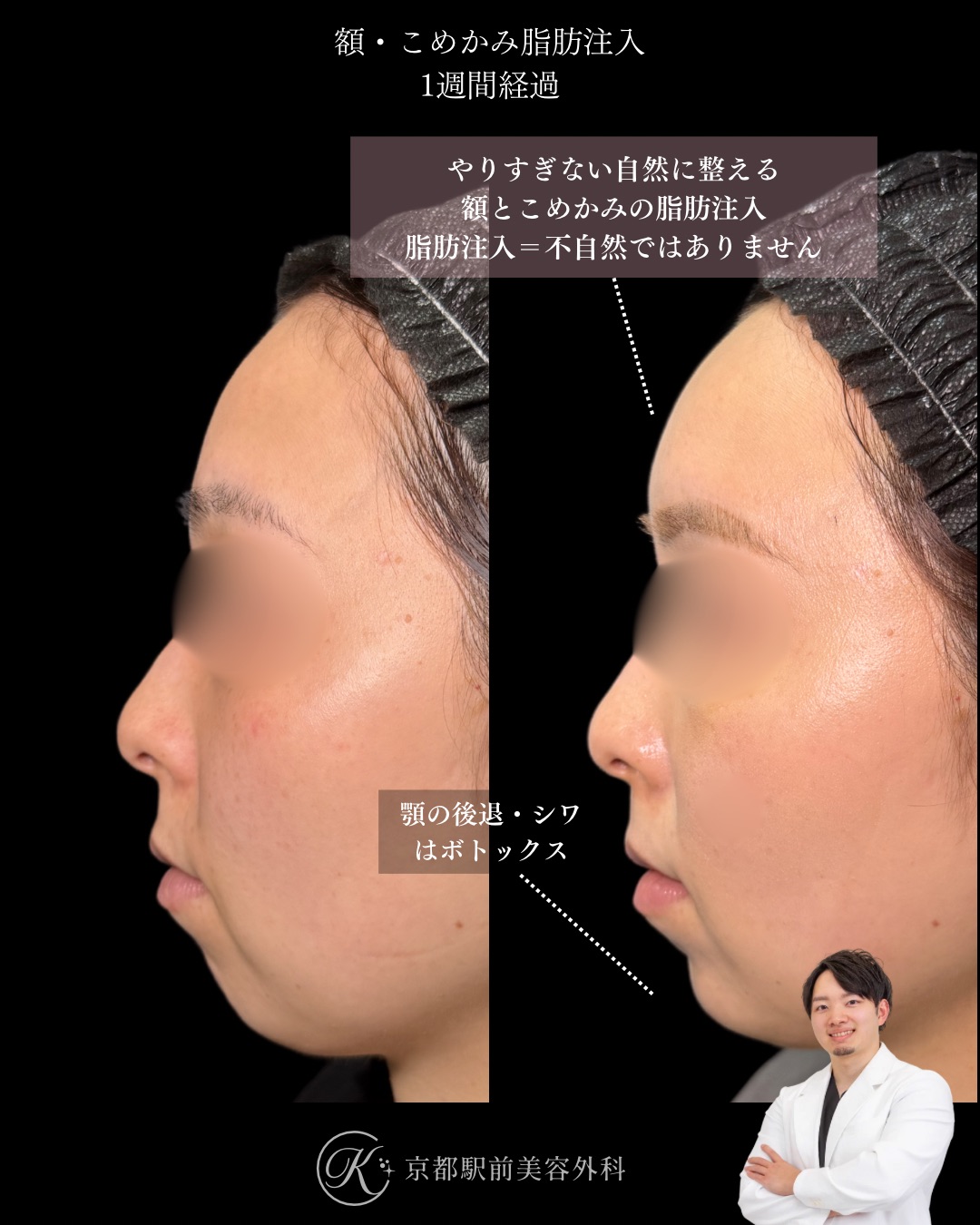 額こめかみの脂肪注入、顎のボトックス・ヒアルロン酸の症例（京都駅前美容外科の症例写真）。額やこめかみの凹みや痩せを改善し、女性らしい丸い額を作ります。当院は滋賀、京都、大阪をはじめとした関西圏や全国から患者様にお越しいただいています。