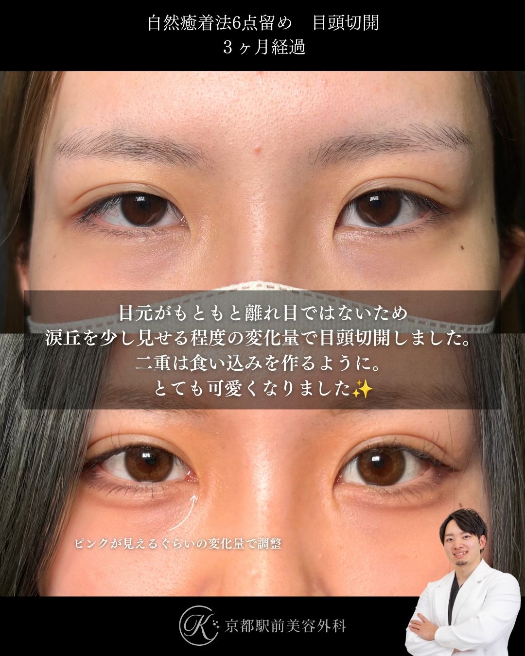 二重埋没法（自然癒着法法6点留め）＋目頭切開の３ヶ月経過写真（京都駅前美容外科の症例）当院は滋賀、京都、大阪をはじめとした関西圏や全国から患者様にお越しいただいています。
