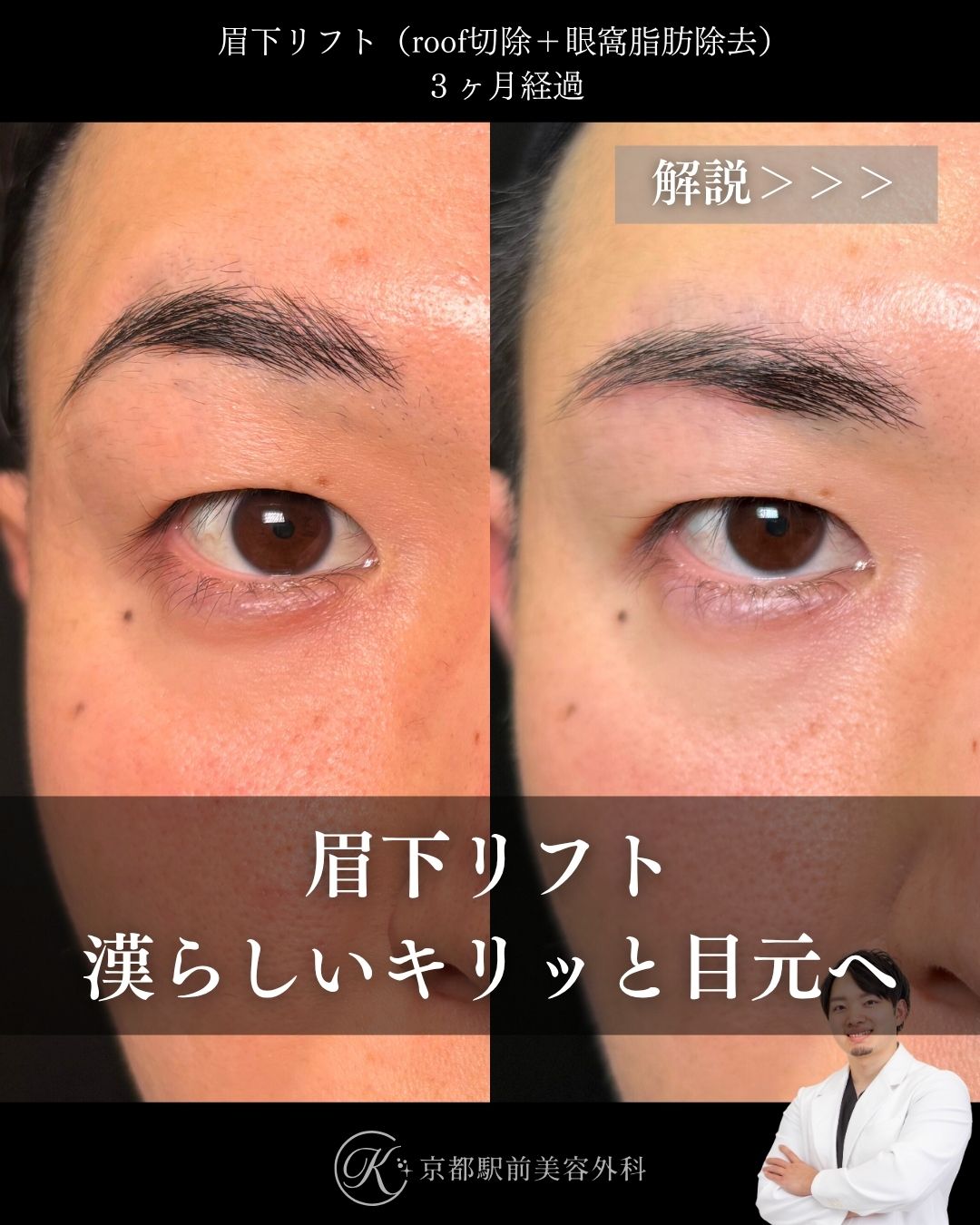 眉下リフト、眼窩脂肪除去、roof除去の術後経過。京都駅前美容外科の症例画像。当院は滋賀、京都、大阪をはじめとした関西圏や全国から患者様にお越しいただいています。