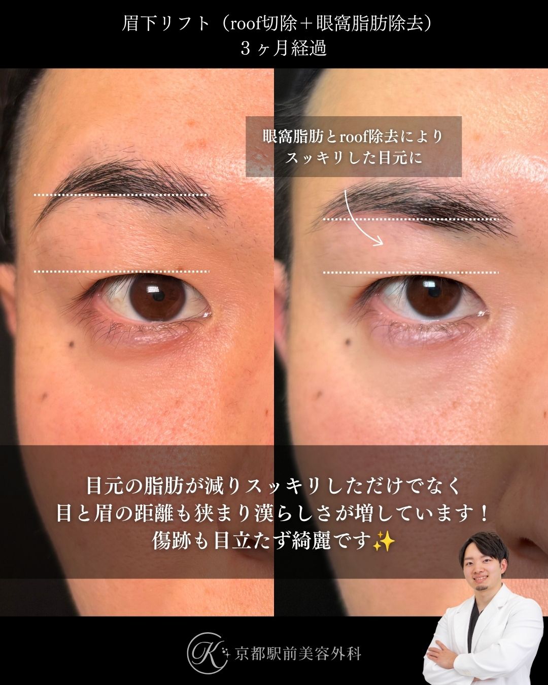 眉下切開（眉下リフト）、眼窩脂肪除去、roof除去の術後経過。京都駅前美容外科の症例画像。当院は滋賀、京都、大阪をはじめとした関西圏や全国から患者様にお越しいただいています。