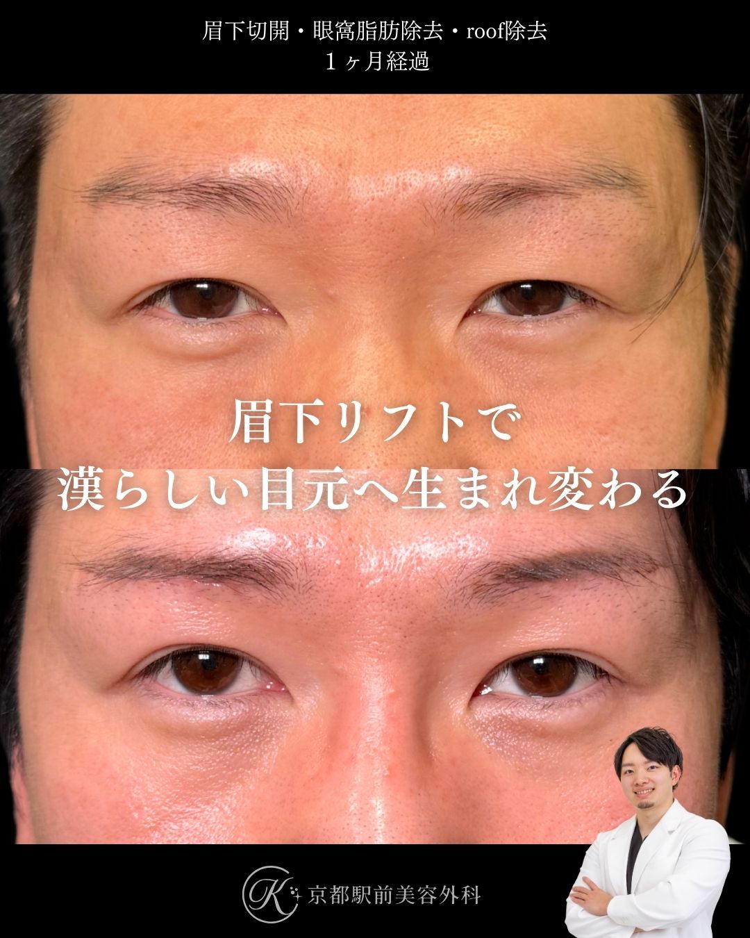 眉下切開（眉下リフト）、眼窩脂肪除去、roof除去の術後経過。京都駅前美容外科の症例画像。当院は滋賀、京都、大阪をはじめとした関西圏や全国から患者様にお越しいただいています。