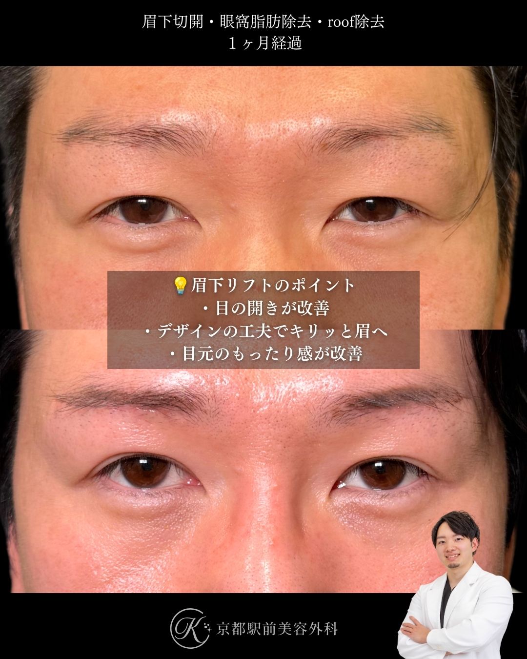 眉下切開（眉下リフト）、眼窩脂肪除去、roof除去の術後経過。京都駅前美容外科の症例画像。当院は滋賀、京都、大阪をはじめとした関西圏や全国から患者様にお越しいただいています。
