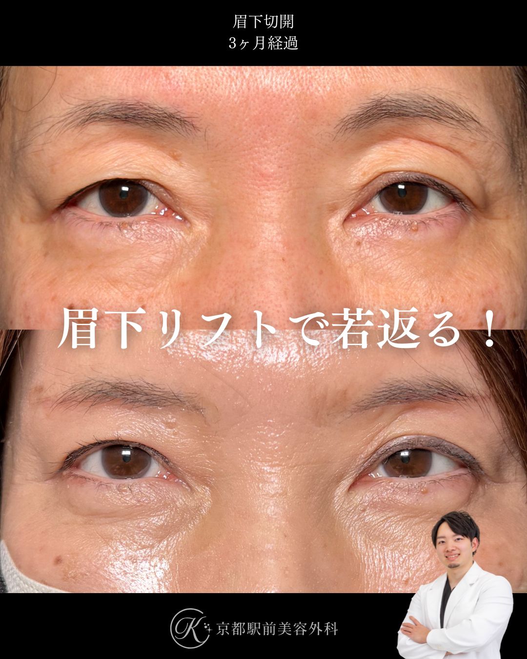 眉下リフト、眼窩脂肪除去、roof除去の術後経過。京都駅前美容外科の症例画像。当院は滋賀、京都、大阪をはじめとした関西圏や全国から患者様にお越しいただいています。