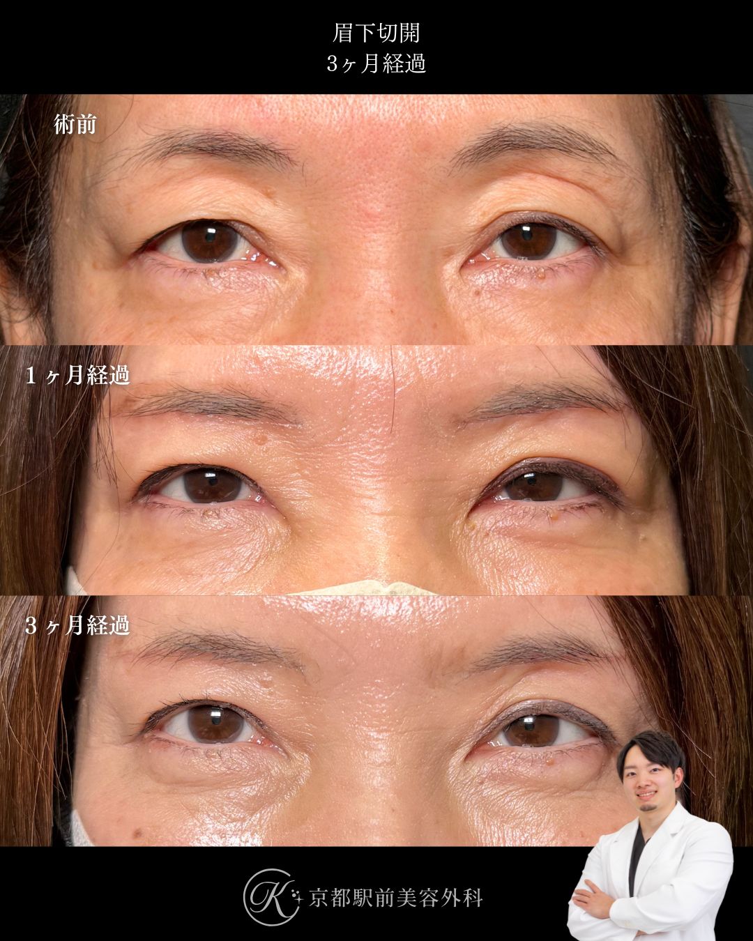 眉下リフト、眼窩脂肪除去、roof除去の術後経過。京都駅前美容外科の症例画像。当院は滋賀、京都、大阪をはじめとした関西圏や全国から患者様にお越しいただいています。