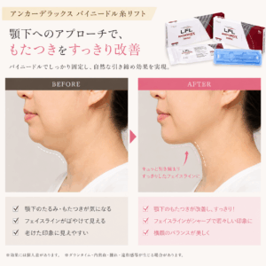 京都駅前美容外科のネックリフト（糸リフトによる）の解説イラスト。