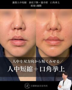裏側人中短縮、口角挙上(全層法)、鼻柱下降、口角挙上の症例(京都駅前美容外科の症例写真)当院は滋賀、京都、大阪をはじめとした関西圏や全国から患者様にお越しいただいています。