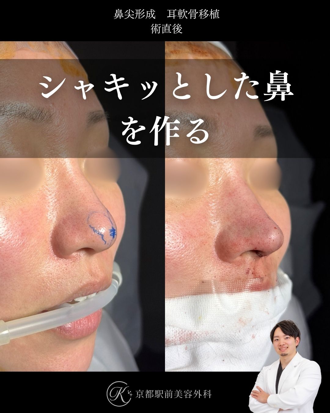 だんご鼻卒業、スッキリした鼻を作る鼻整形。鼻尖形成・耳軟骨移植の経過写真（京都駅前美容外科の鼻整形症例）当院は滋賀、京都、大阪をはじめとした関西圏や全国から患者様にお越しいただいています。