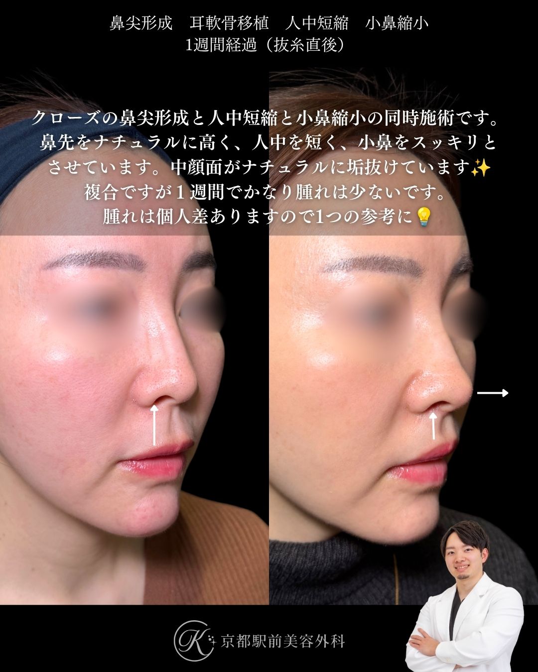 鼻整形、小鼻縮小と人中短縮、中顔面の垢抜けセット（京都駅前美容外科の症例）当院は滋賀、京都、大阪をはじめとした関西圏や全国から患者様にお越しいただいています。
