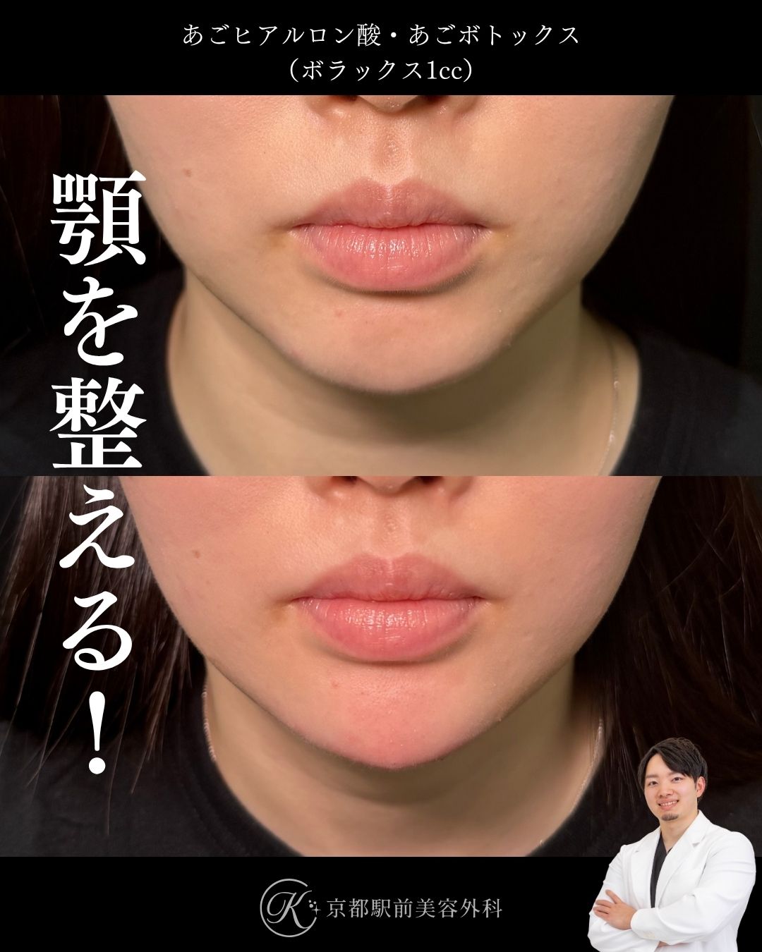 あごヒアルロン酸とあごボトックスであごが整う！京都駅前美容外科の症例画像。当院は滋賀、京都、大阪をはじめとした関西圏や全国から患者様にお越しいただいています。