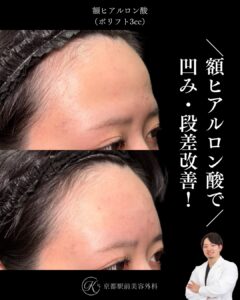 額ヒアルロン酸の症例(京都駅前美容外科の症例写真)。額の凹みや痩せを改善し、女性らしい丸い額を作ります。当院は滋賀、京都、大阪をはじめとした関西圏や全国から患者様にお越しいただいています。