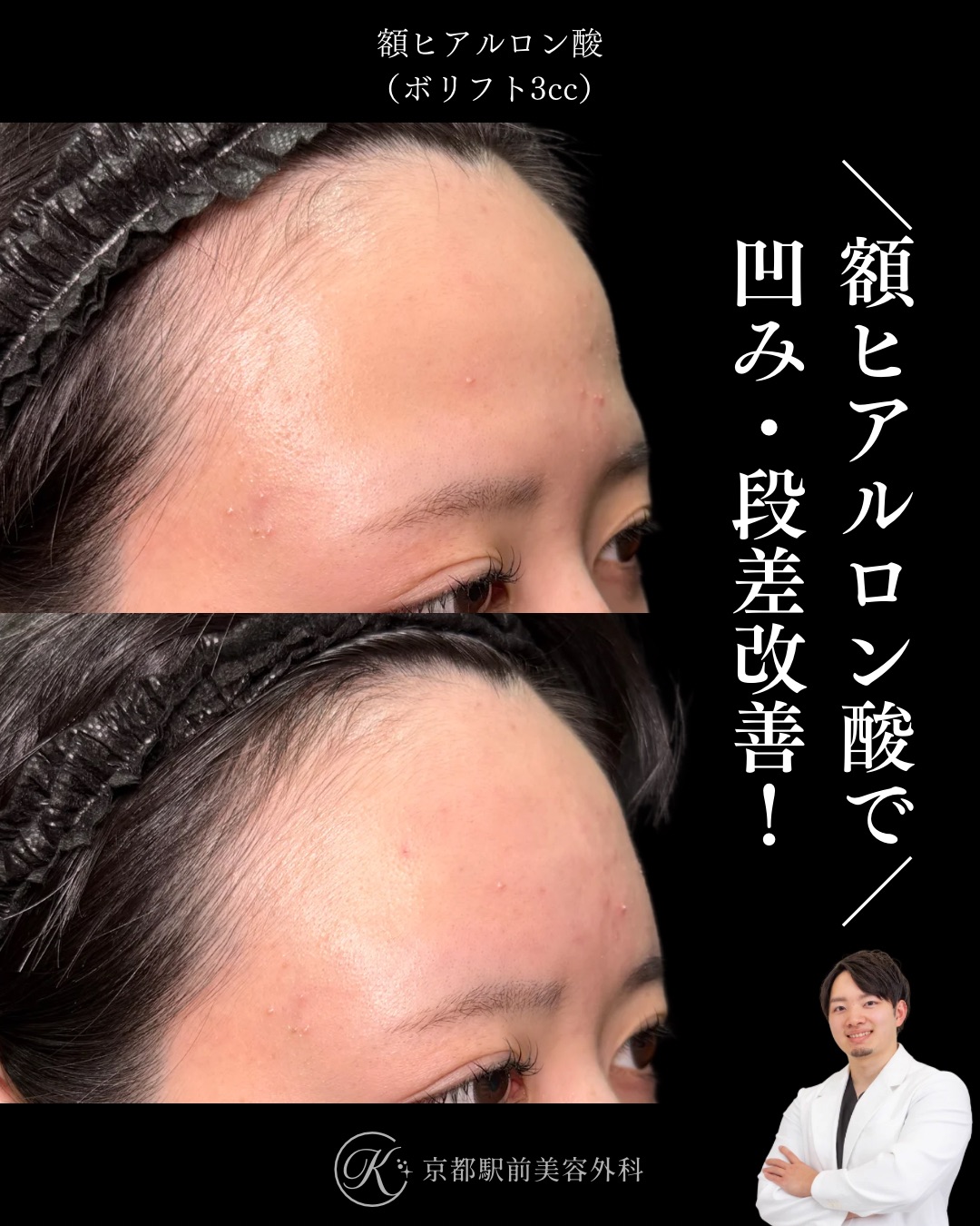額ヒアルロン酸の症例（京都駅前美容外科の症例写真）。額の凹みや痩せを改善し、女性らしい丸い額を作ります。当院は滋賀、京都、大阪をはじめとした関西圏や全国から患者様にお越しいただいています。