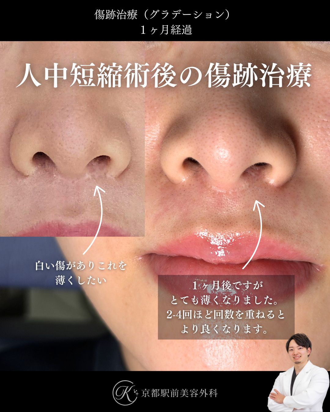 傷跡治療・傷跡修正（グラデーション治療）の症例画像。人中短縮と小鼻縮小によりできた傷跡の写真など（京都駅前美容外科の症例写真）当院は滋賀、京都、大阪をはじめとした関西圏や全国から患者様にお越しいただいています。