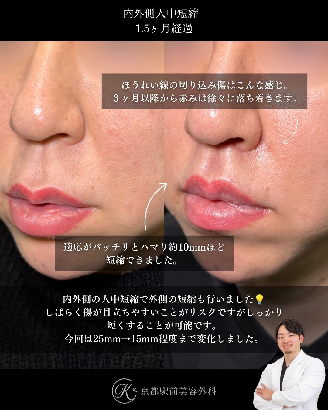 内外側人中短縮（拡大人中短縮）の症例写真（京都駅前美容外科の症例）当院は滋賀、京都、大阪をはじめとした関西圏や全国から患者様にお越しいただいています。