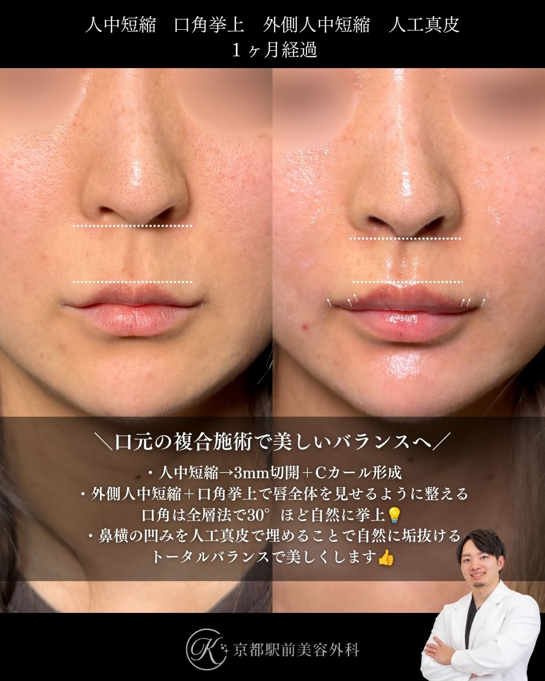 人中短縮、口角挙上、外側人中短縮、人工真皮の術後経過。京都駅前美容外科の症例画像。当院は滋賀、京都、大阪をはじめとした関西圏や全国から患者様にお越しいただいています。