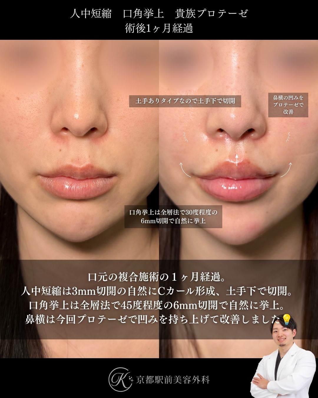 人中短縮、口角挙上、貴族プロテーゼの術後経過。京都駅前美容外科の症例画像。当院は滋賀、京都、大阪をはじめとした関西圏や全国から患者様にお越しいただいています。