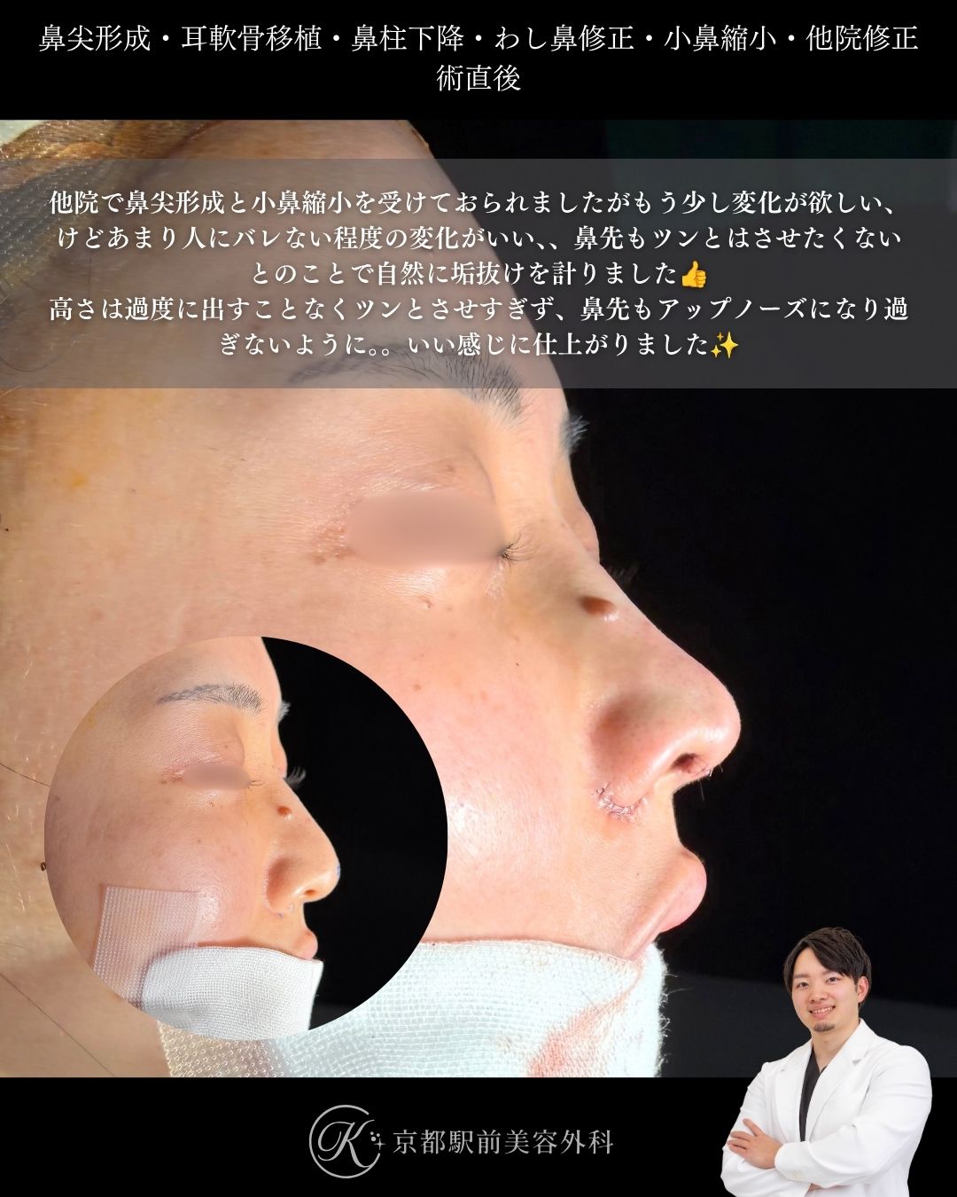 鼻整形の修正（鼻尖形成・耳軟骨移植・小鼻縮小・わし鼻修正・鼻柱下降・他院修正）の術直後写真（京都駅前美容外科の鼻整形症例）当院は滋賀、京都、大阪をはじめとした関西圏や全国から患者様にお越しいただいています。
