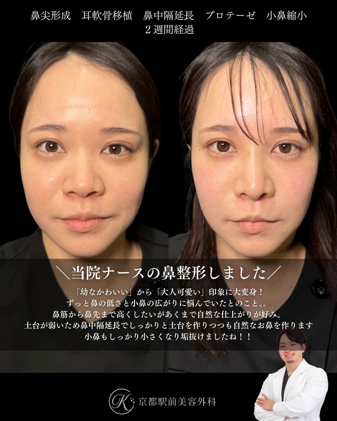 肋軟骨による鼻整形、小鼻縮小、プロテーゼの症例写真（京都駅前美容外科の鼻整形症例）当院は滋賀、京都、大阪をはじめとした関西圏や全国から患者様にお越しいただいています。