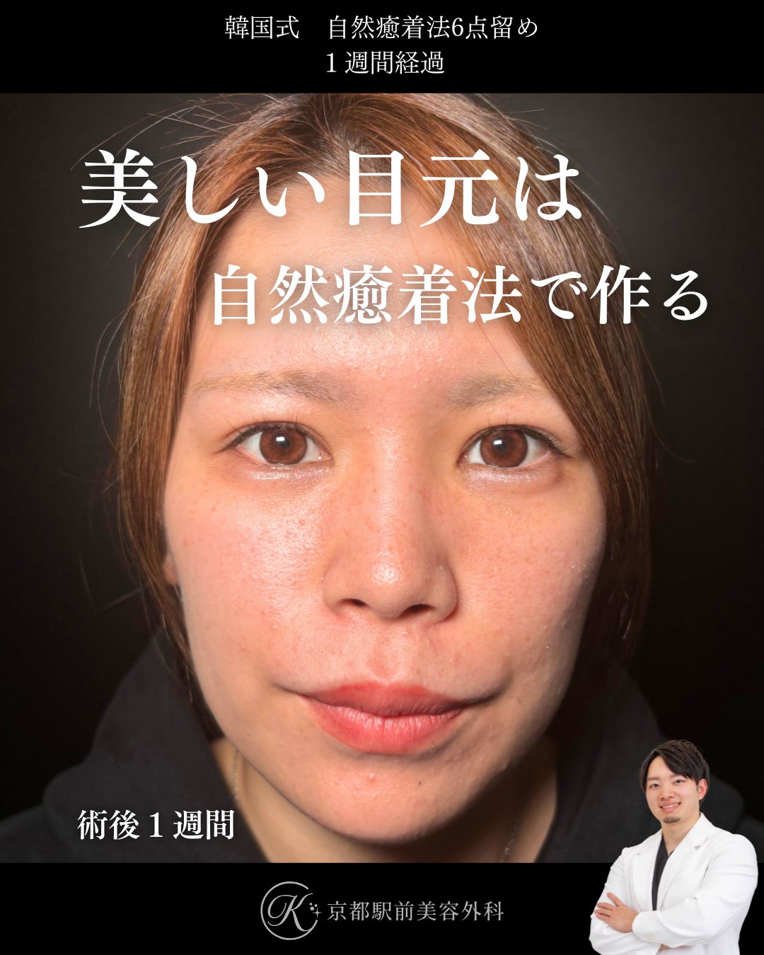 二重埋没法（自然癒着法法6点留め）の１週間後経過写真（京都駅前美容外科の症例）当院は滋賀、京都、大阪をはじめとした関西圏や全国から患者様にお越しいただいています。