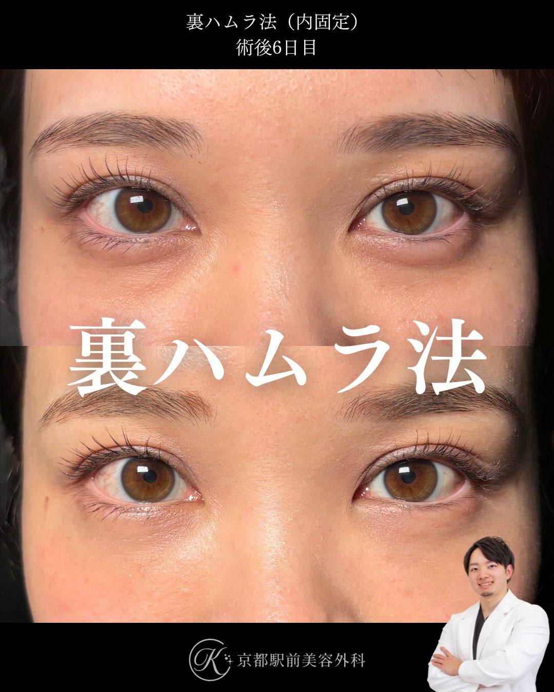 裏ハムラ法（クマ取り）の１週間後経過の写真です（京都駅前美容外科の症例）。目の下の膨らみとその下の凹み・溝を改善させます。目の表の皮膚を切らないため傷跡は直後からわかりません。クマを治すことで、若々しいお目元へと変化させることができます。当院は滋賀、京都、大阪をはじめとした全国から患者様にお越しいただいています。