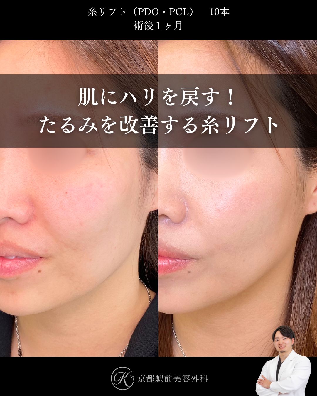 肌にハリを戻す！たるみを改善する糸リフト。京都駅前美容外科の症例画像。当院は滋賀、京都、大阪をはじめとした関西圏や全国から患者様にお越しいただいています。