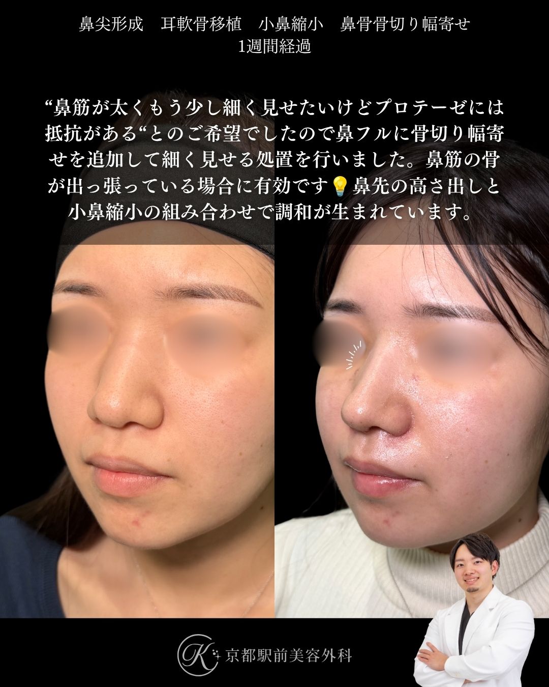 鼻筋から鼻先まで洗練、骨切り含む鼻整形。鼻尖形成・耳軟骨移植・小鼻縮小・鼻骨骨切り幅寄せの１ヶ月経過写真（京都駅前美容外科の鼻整形症例）当院は滋賀、京都、大阪をはじめとした関西圏や全国から患者様にお越しいただいています。