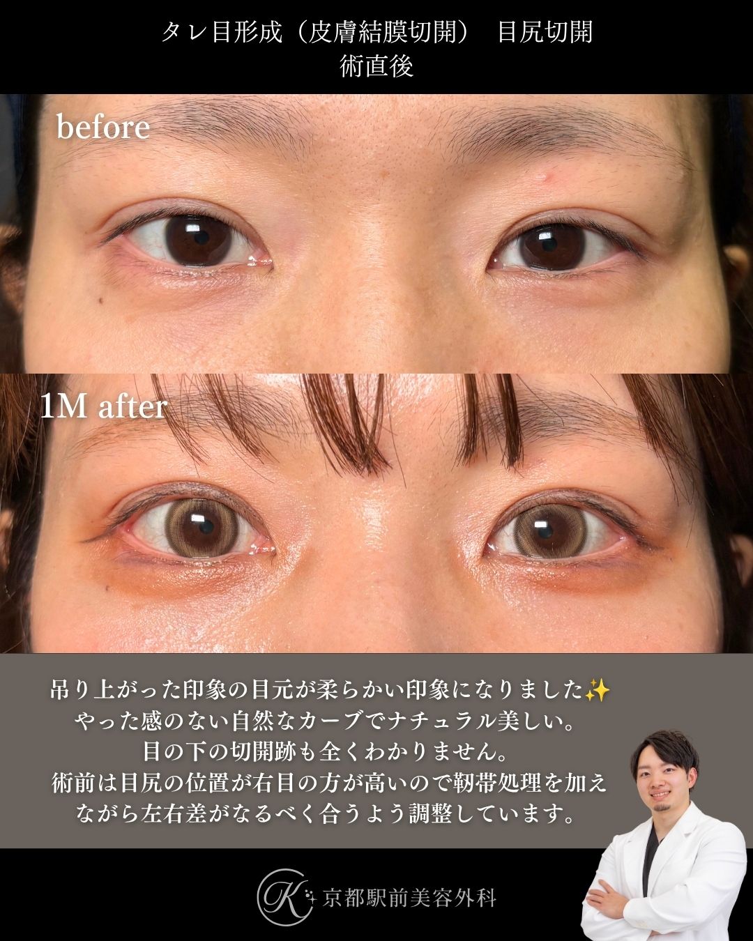 タレ目形成（グラマラスライン形成）（皮膚結膜）、目尻切開の術後経過。京都駅前美容外科の症例画像。当院は滋賀、京都、大阪をはじめとした関西圏や全国から患者様にお越しいただいています。