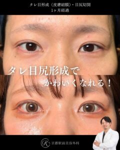 タレ目形成(グラマラスライン形成)(皮膚結膜)、目尻切開の術後経過。京都駅前美容外科の症例画像。当院は滋賀、京都、大阪をはじめとした関西圏や全国から患者様にお越しいただいています。
