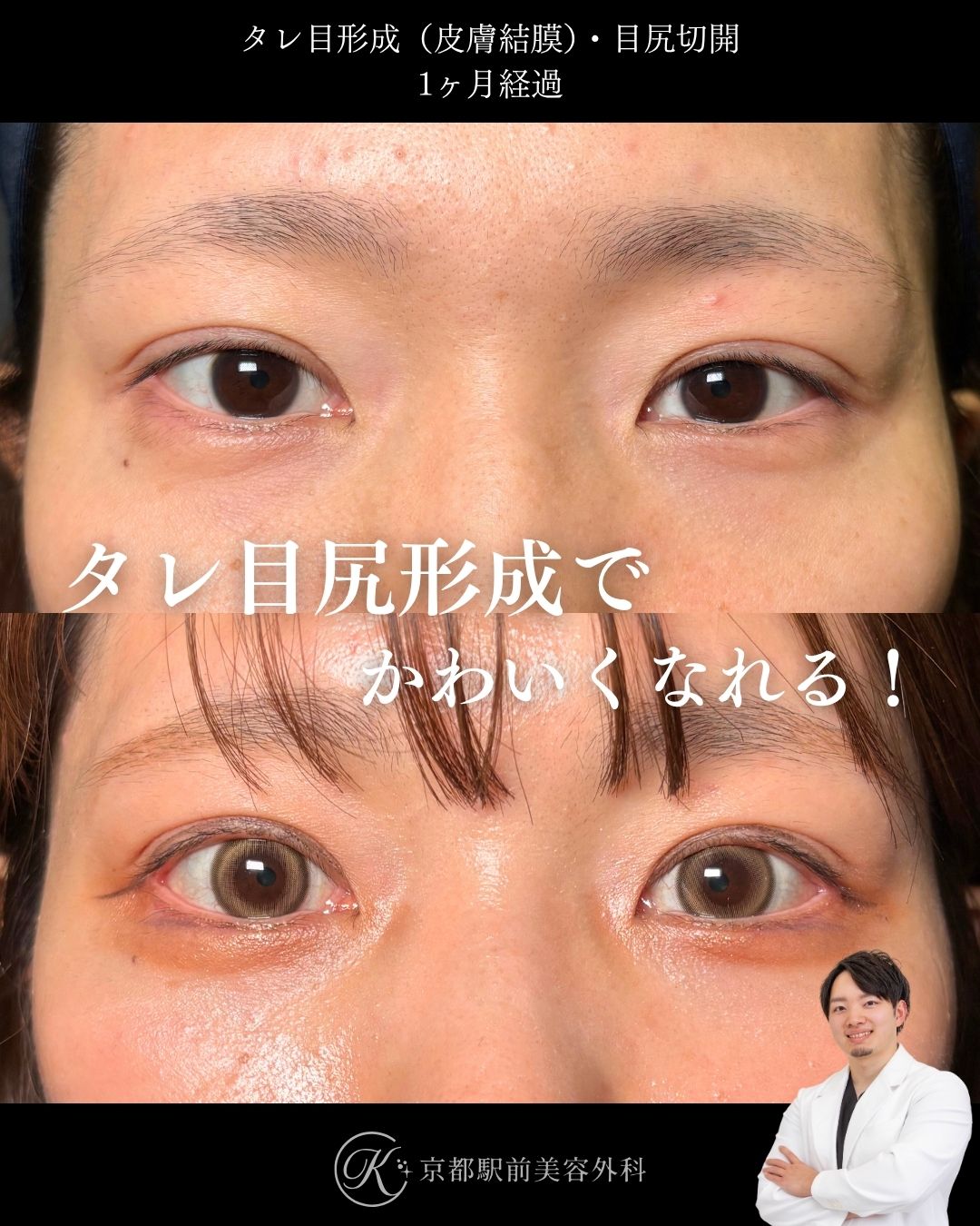 タレ目形成（グラマラスライン形成）（皮膚結膜）、目尻切開の術後経過。京都駅前美容外科の症例画像。当院は滋賀、京都、大阪をはじめとした関西圏や全国から患者様にお越しいただいています。
