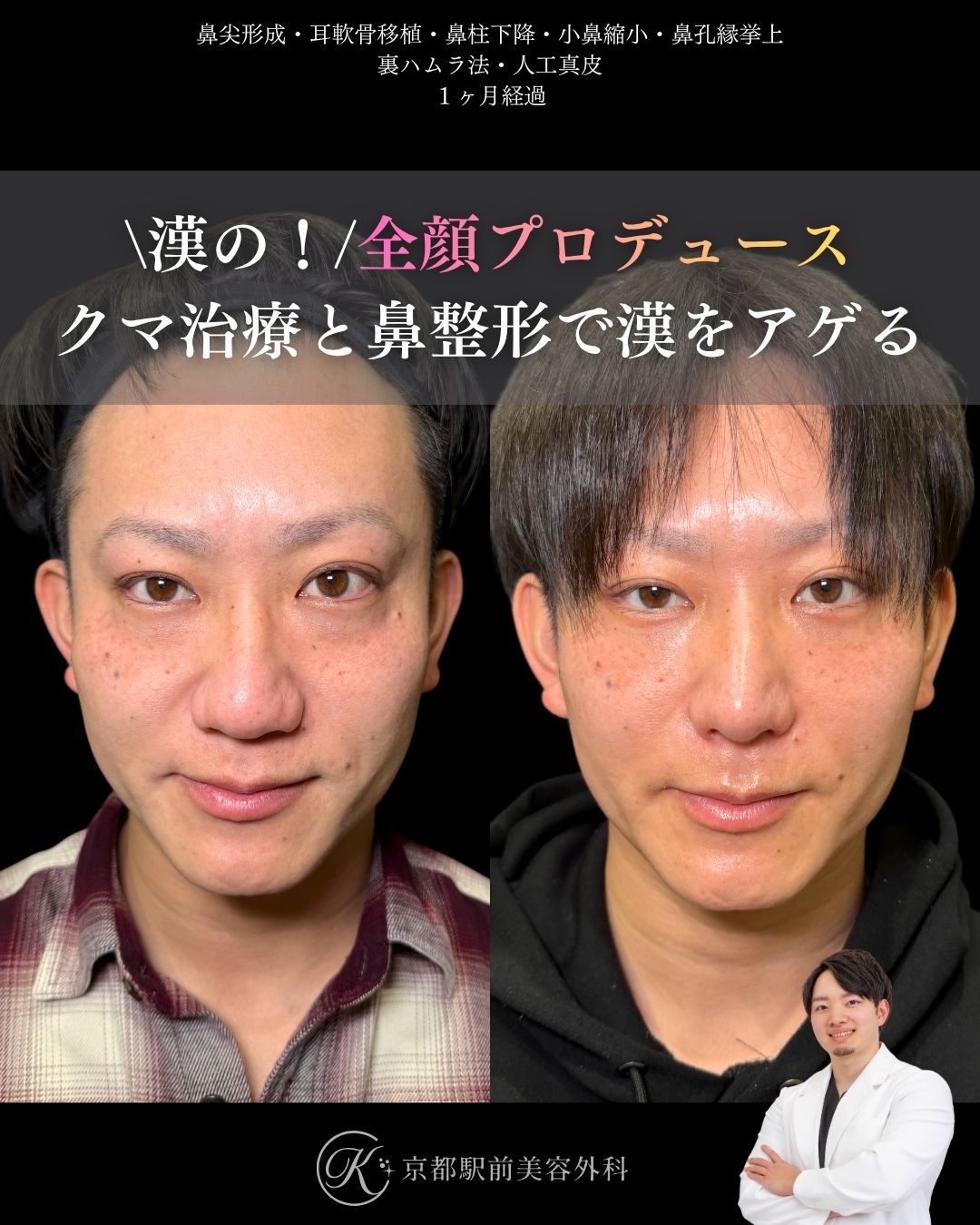 鼻尖形成・耳軟骨移植・小鼻縮小・鼻孔縁挙上・人工真皮・裏ハムラ法の術後経過写真（京都駅前美容外科の症例写真）当院は滋賀、京都、大阪をはじめとした関西圏や全国から患者様にお越しいただいています。