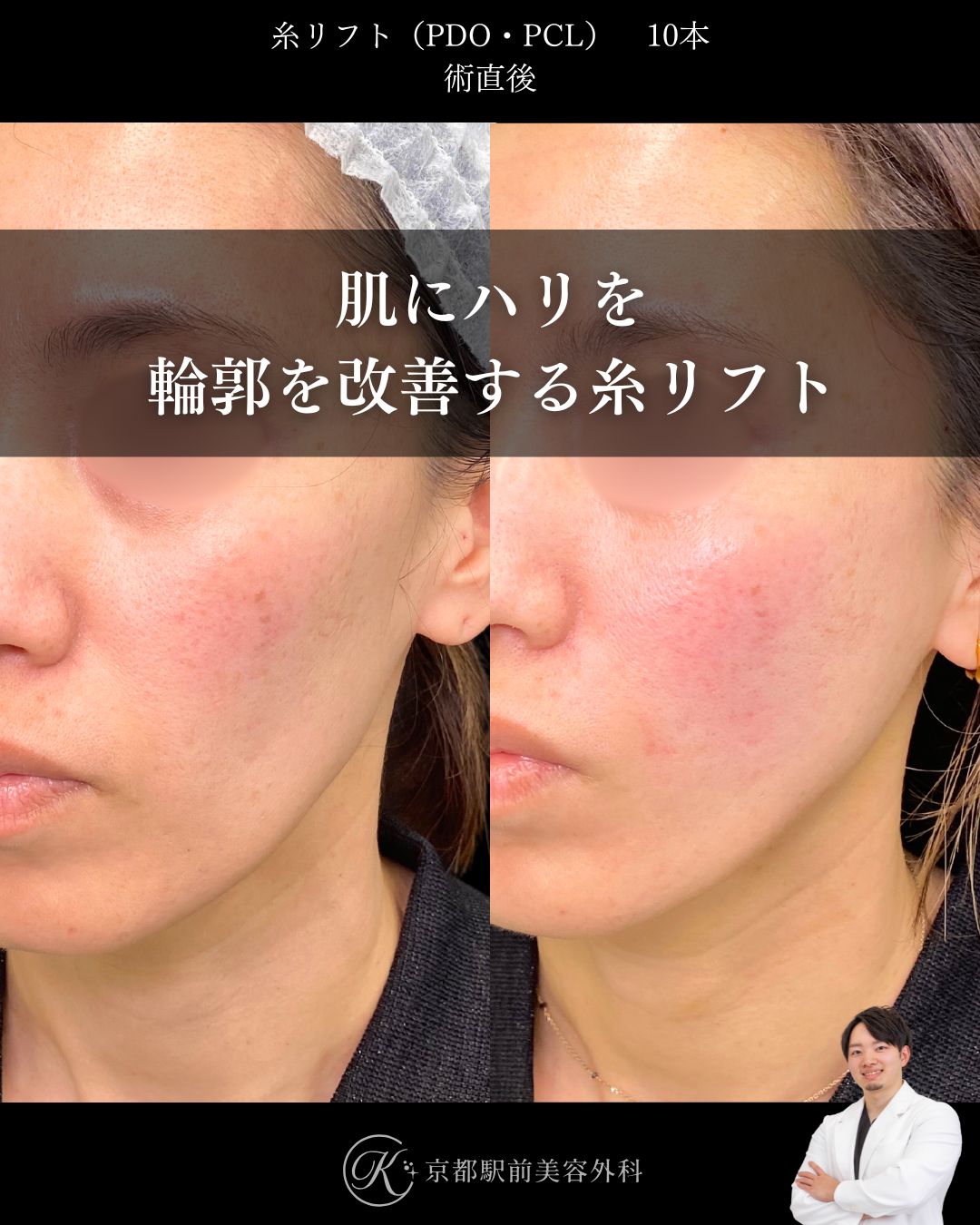 肌にハリを戻す！たるみを改善する糸リフト。京都駅前美容外科の症例画像。当院は滋賀、京都、大阪をはじめとした関西圏や全国から患者様にお越しいただいています。