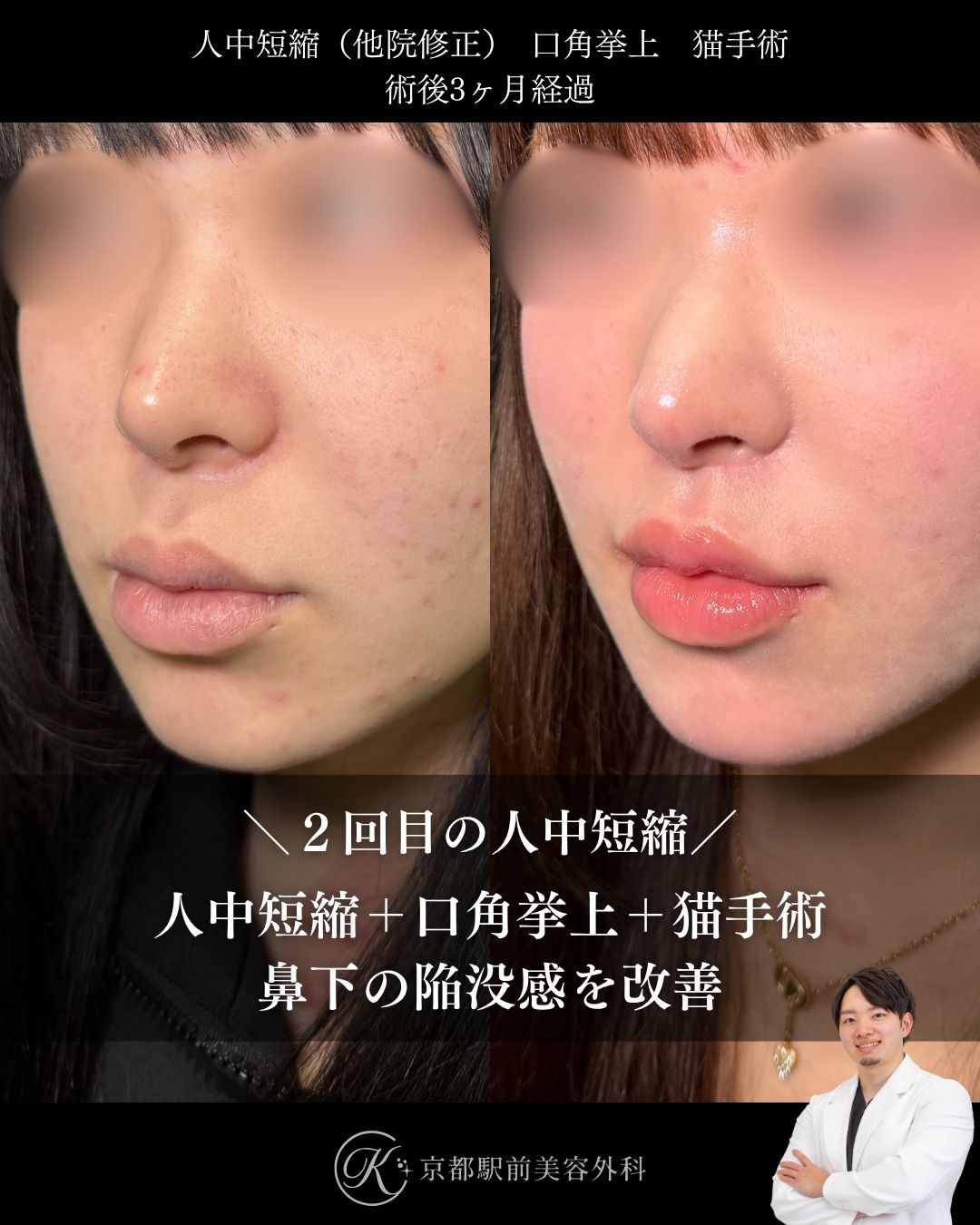 ２回目の人中短縮。人中短縮、口角挙上、猫手術（鼻唇角形成）の術後経過。京都駅前美容外科の症例画像。当院は滋賀、京都、大阪をはじめとした関西圏や全国から患者様にお越しいただいています。